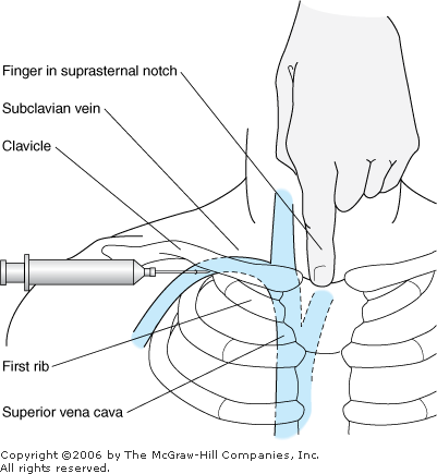 Subclavian venous catheter insertion